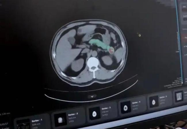 老人头晕3天AI主动报警查出癌症